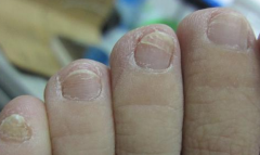 灰指甲用什么有效？知足抗菌足膜能根治